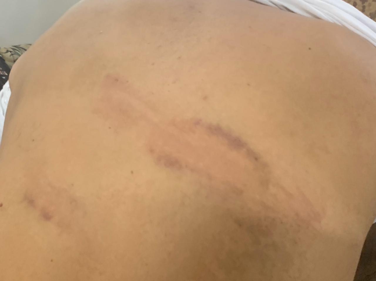 Saeed Ali Achakzai, reporter for Urdu-language channel, Samaa News, shows bruises from beating by law enforcement officers. Courtesy of Saeed Ali Achakzai.